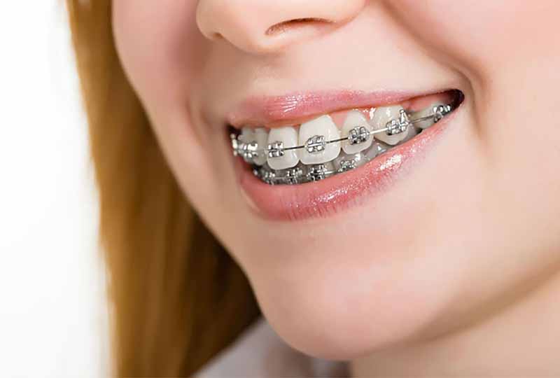Chi phí niềng răng hô hàm thường phụ thuộc vào nhiều yếu tố khác nhau