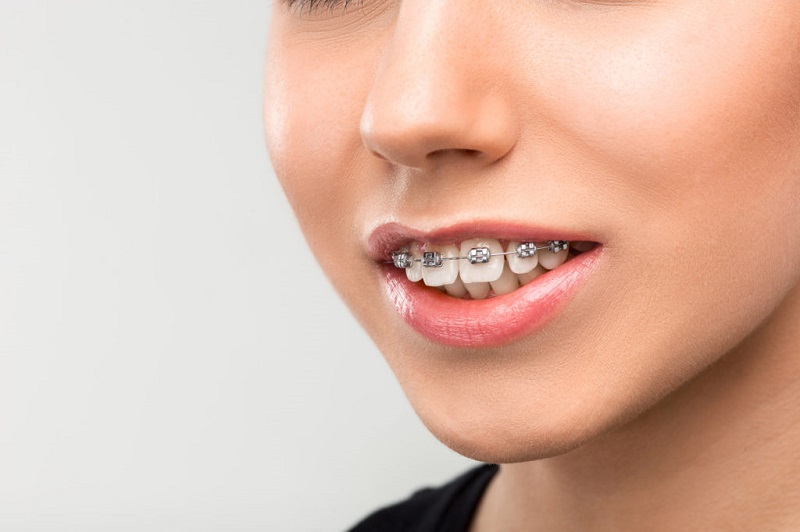 Mức giá niềng răng hô mắc cài kim loại thường dao động từ 25 - 45 triệu/2 hàm