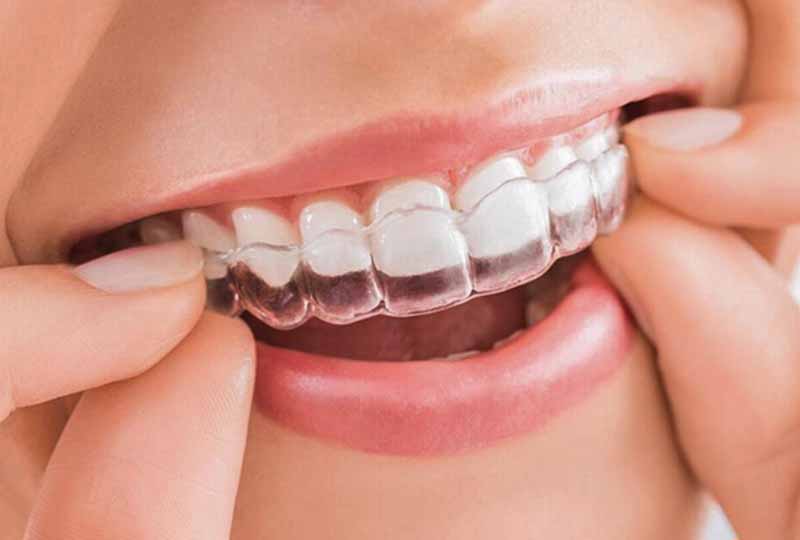 Người bệnh nên lựa chọn kỹ thuật niềng phù hợp với tình trạng răng miệng để đạt kết quả tốt nhất