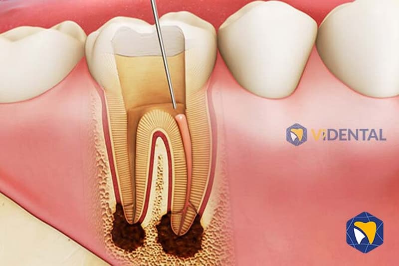Lựa chọn điều trị tủy răng tại Vidental giúp loại bỏ triệt để tình trạng đau nhức, khó chịu