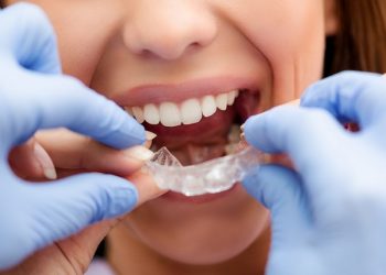 Chi phí niềng răng cho mỗi bệnh nhân luôn khác nhau và phụ thuộc vào nhiều yếu tố