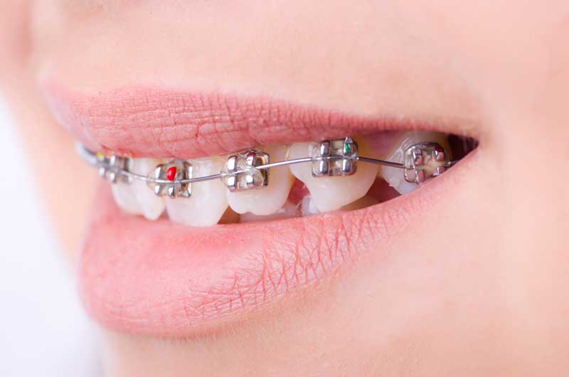 Giá niềng răng khấp khểnh phụ thuộc vào nhiều yếu tố như tình trạng răng, phương pháp niềng, độ tuổi… 