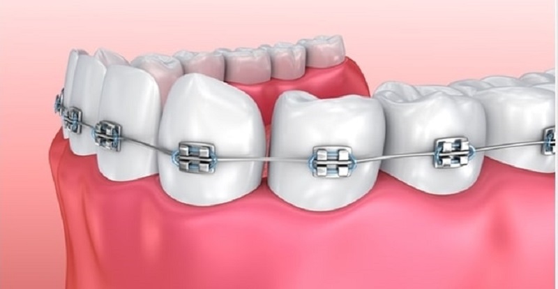 Chi phí niềng răng mắc cài kim loại tự buộc thường dao động từ 28 - 38 triệu