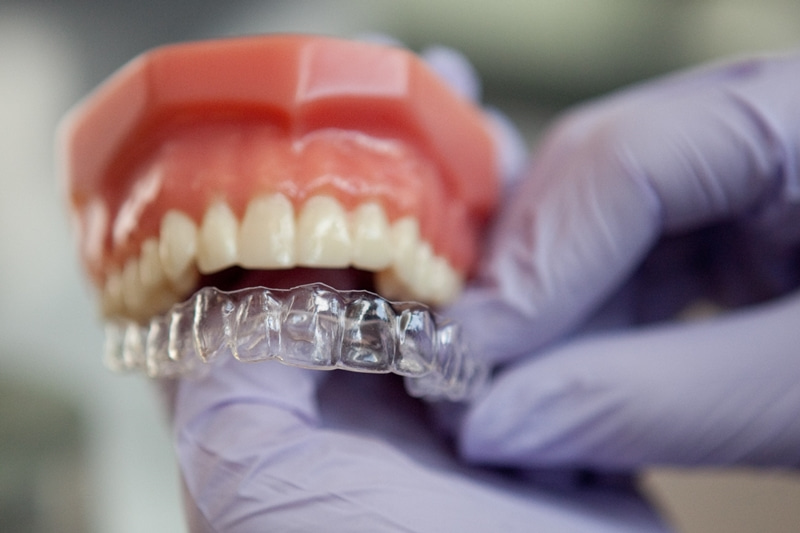 Mức giá niềng răng trong suốt thường tốn kém hơn các kỹ thuật niềng răng với mắc cài