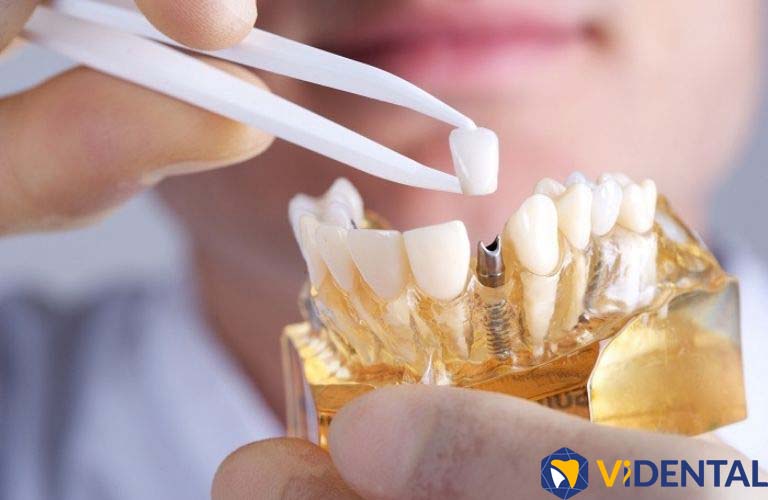 Phương pháp cấy ghép implant là một trong những giải pháp mà chuyên gia bác sĩ tại ViDental gợi ý cho người mất răng