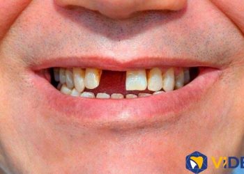 Tình trạng mất răng mà khách hàng thường gặp phải