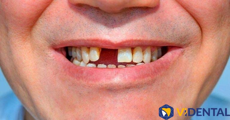 Chuyên gia bác sĩ tại ViDental cảnh báo tình trạng mất răng sẽ ảnh hưởng rất nghiêm trọng đến sức khỏe. 