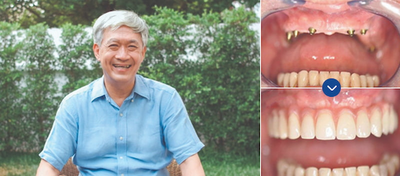 Ông Trần Văn Đan - Khách hàng trồng răng Implant tại Nha khoa ViDental