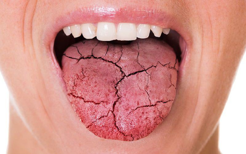 Khô miệng là một tình trạng phổ biến mang lại cảm giác khá khó chịu cho người bệnh
