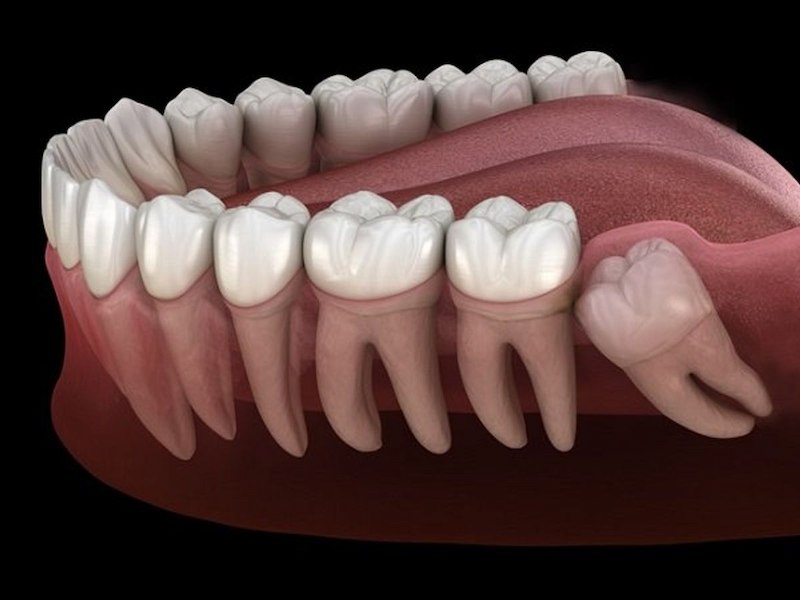 Nhiều trường hợp răng khôn hàm dưới bên trái bị mọc lệch gây đau nhức, khó chịu
