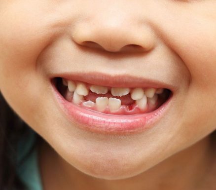 Nhổ răng sữa mọc lệch cho trẻ cần được thực hiện ở nha khoa