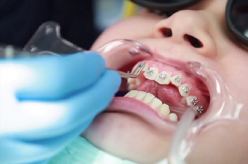 Nếu niềng răng đúng kỹ thuật thì thời gian thực hiện trung bình sẽ mất khoảng 1,5 đến 2 năm