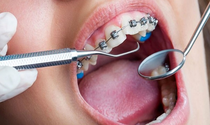 Muốn niềng răng 1 hàm, bạn cũng cần phải có đầy đủ 3 yếu tố cơ bản