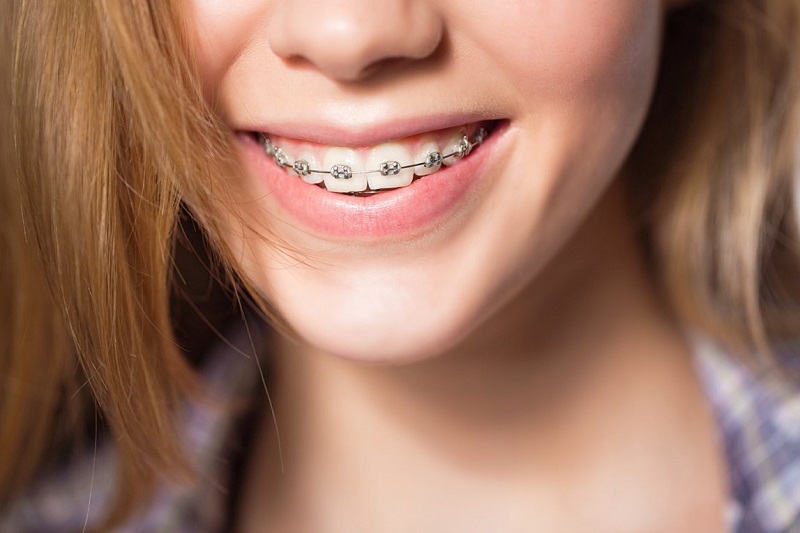 Niềng răng 1 hàm có thể thực hiện ở nhiều trường hợp khác nhau như răng hô, móm, lệch lạc hoặc thưa