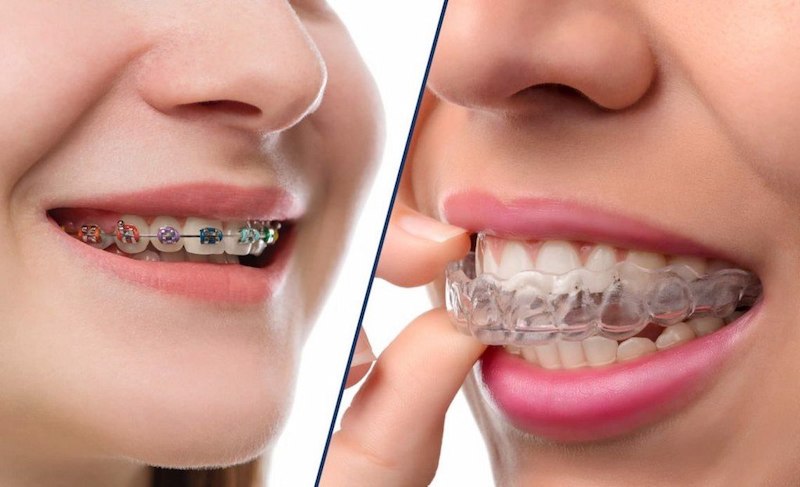Niềng răng Ecligner có nhiều ưu điểm hơn so với phương pháp niềng răng truyền thống
