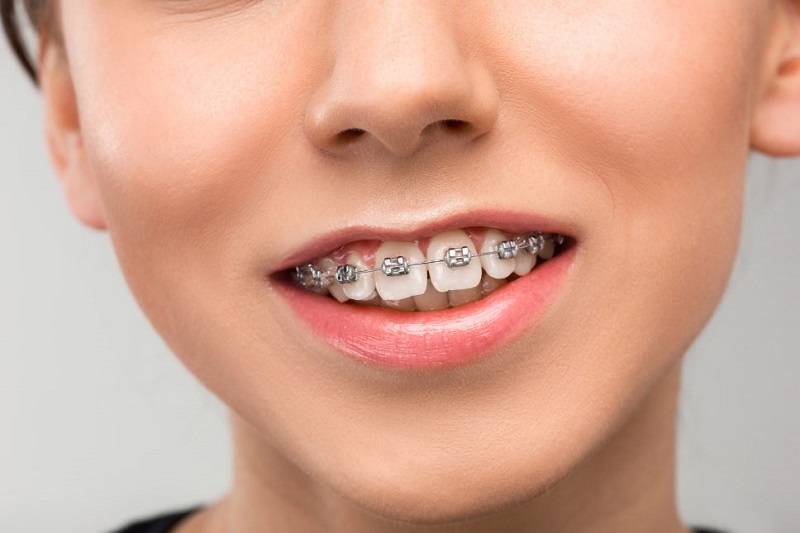 Niềng răng hô hàm trên là phương pháp sử dụng khí cụ để nắn chỉnh răng về vị trí tiêu chuẩn