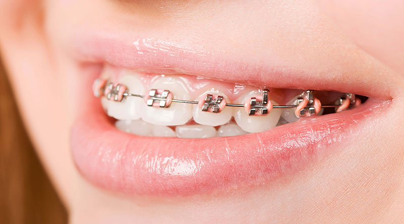Niềng răng mắc cài kim loại thường mang đến hiệu quả chỉnh nha cao nhưng kém thẩm mỹ