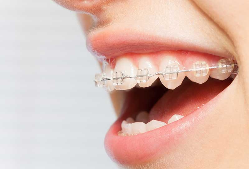 Chi phí niềng răng hô hàm trên mắc cài sứ sẽ dao động từ 22,5 - 30 triệu