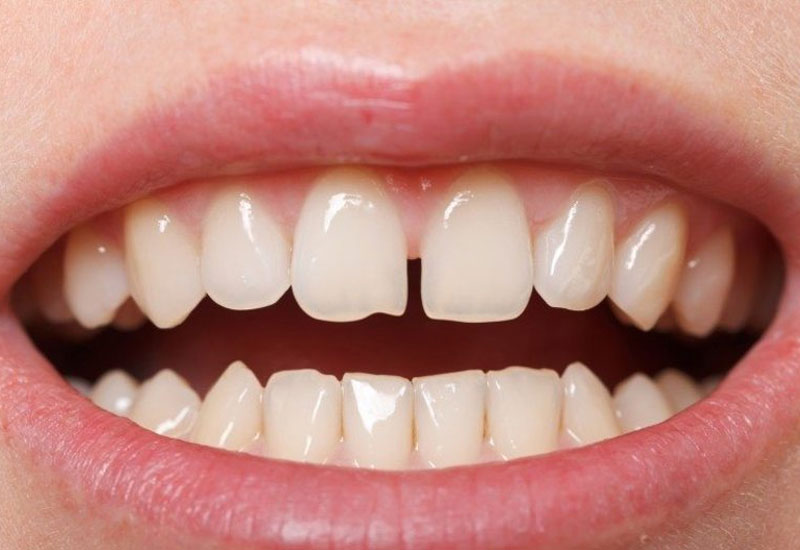Tình trạng răng bị thưa có thể được xử lý bằng nhiều biện pháp khác nhau