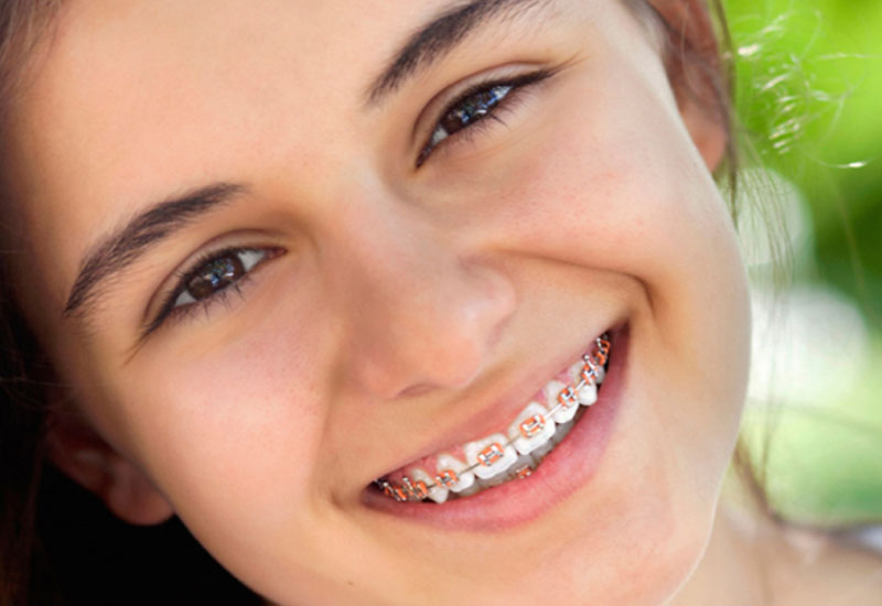 Niềng răng là phương pháp chỉnh nha hiệu quả nhất trong trường hợp răng mọc lệch