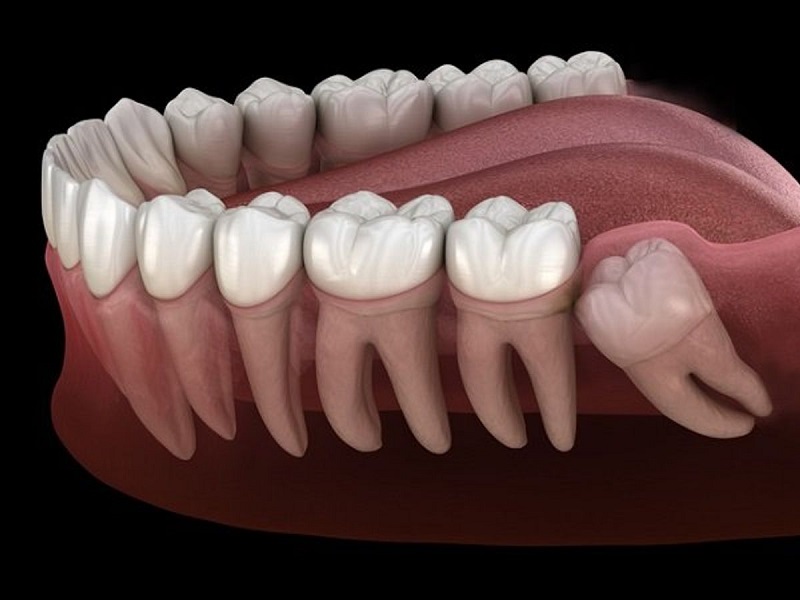 Hình ảnh minh họa răng khôn mọc chệch hướng và đâm vào răng kế cận