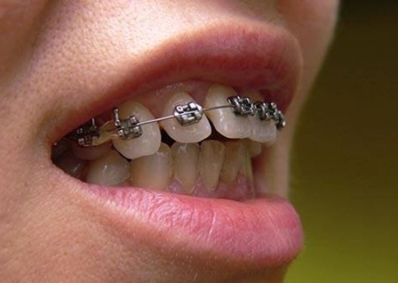 Bạn có thể niềng răng hoặc làm răng sứ để cải thiện tình trạng răng mọc không đúng khuôn hàm