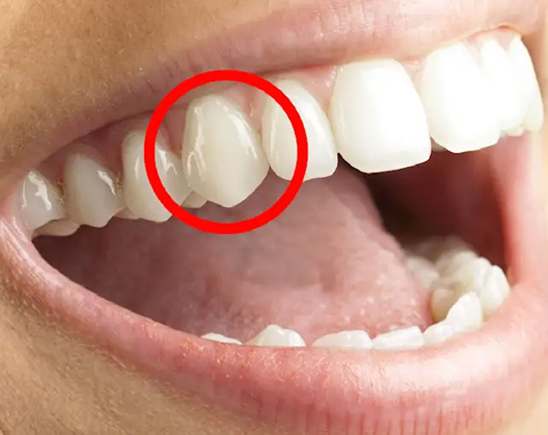 Răng nanh nằm ở vị trí số 3 trên cung hàm