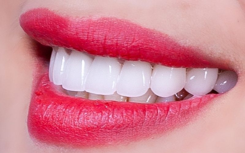 Bọc răng sứ phù hợp cho những trường hợp lệch lạc nhẹ