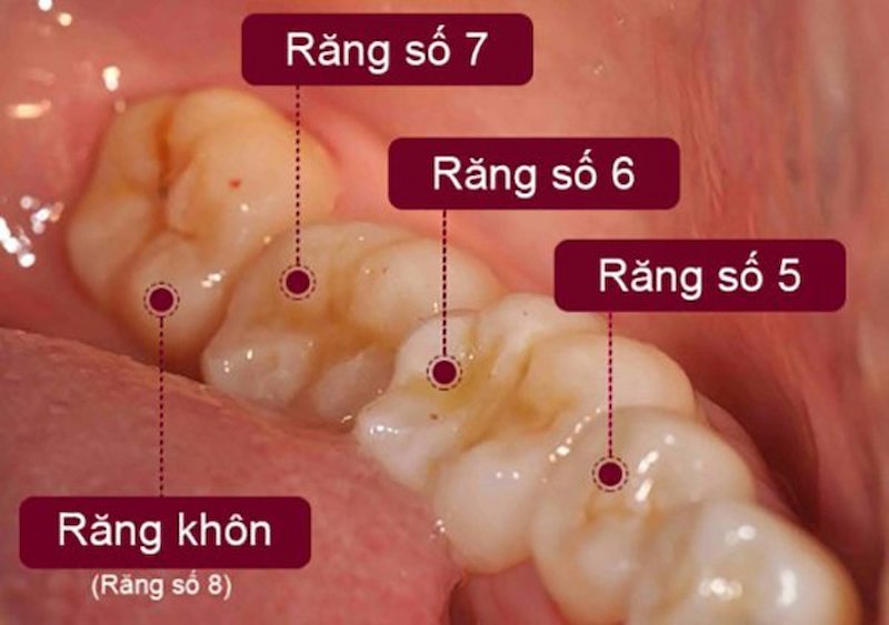 Răng cấm là răng số 6 và số 7 trên cung hàm