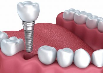 Trồng răng cấm hết bao nhiêu tiền phụ thuộc vào nhiều yếu tố khác nhau