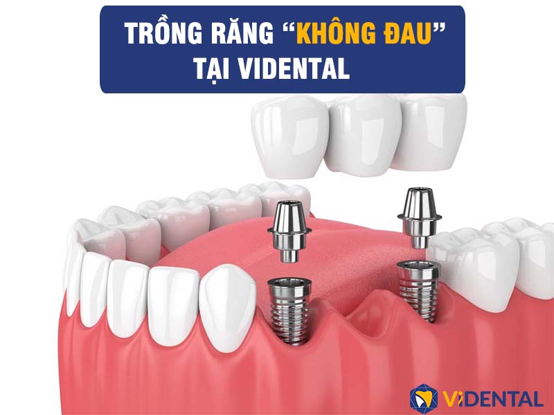 Trồng răng Implant là một trong những dịch vụ nổi bật tại Nha Khoa ViDental