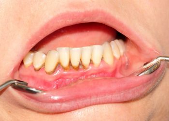 Cao răng tích tụ gây ra nhiều bệnh lý nguy hiểm
