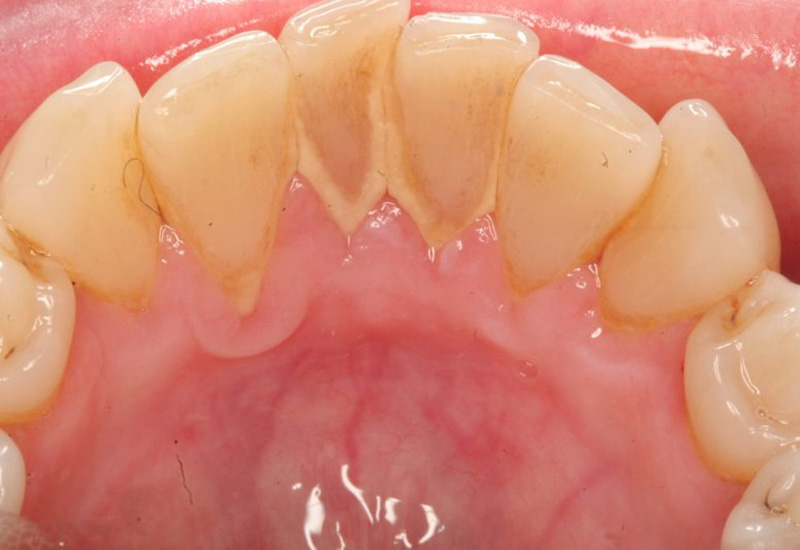 Cao răng tích tụ do vi khuẩn tác động lên các mảng bám và thức ăn thừa