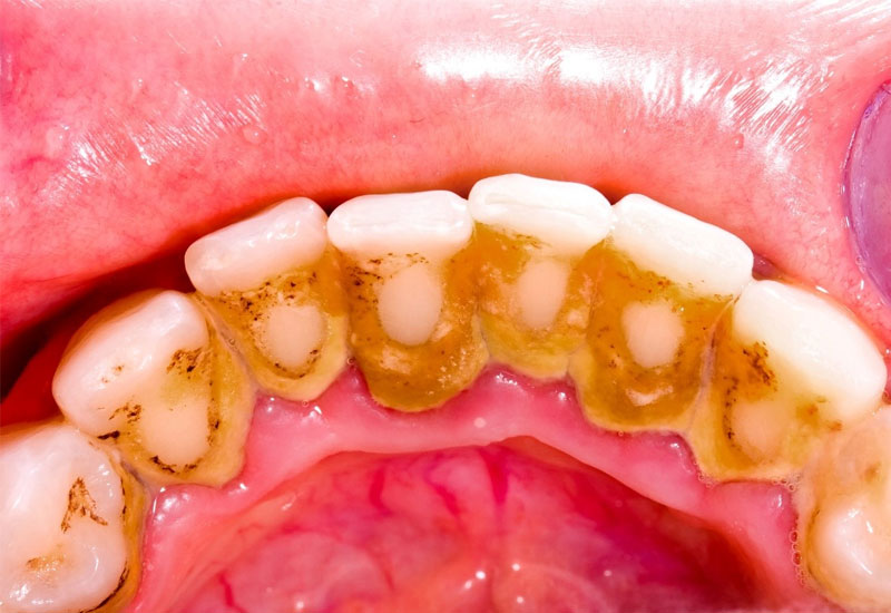 Vôi răng không chỉ ảnh hưởng đến thẩm mỹ mà còn gây ra nhiều bệnh lý nguy hiểm