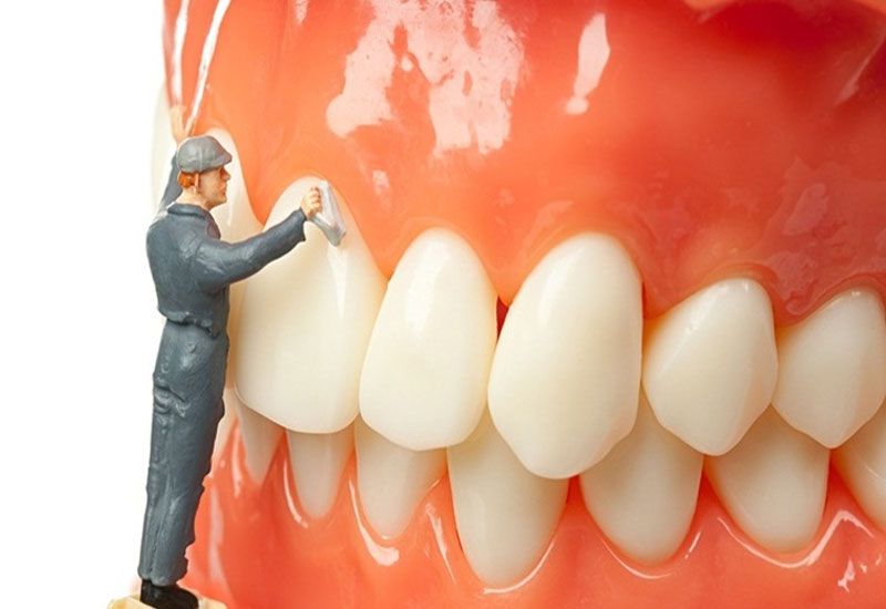 Để bảo vệ sức khỏe răng miệng, việc lấy cao răng định kỳ là cần thiết