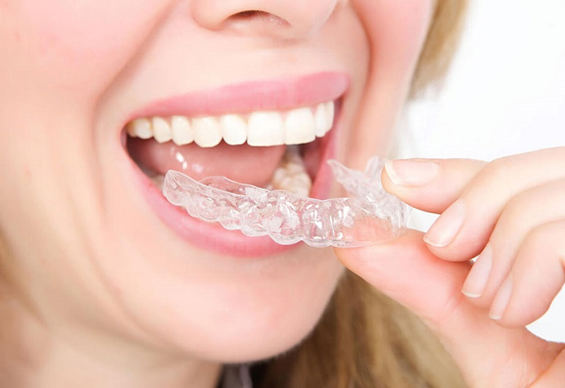Điểm đặc biệt của phương pháp niềng răng hô bằng nhựa là sử dụng khay niềng trong suốt