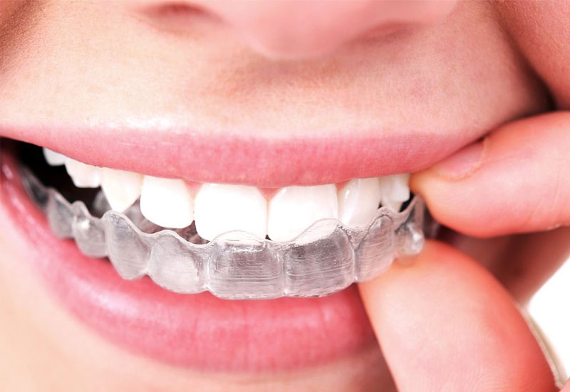 Niềng răng Invisalign được cho là phương pháp niềng hiệu quả và nhanh chóng hơn