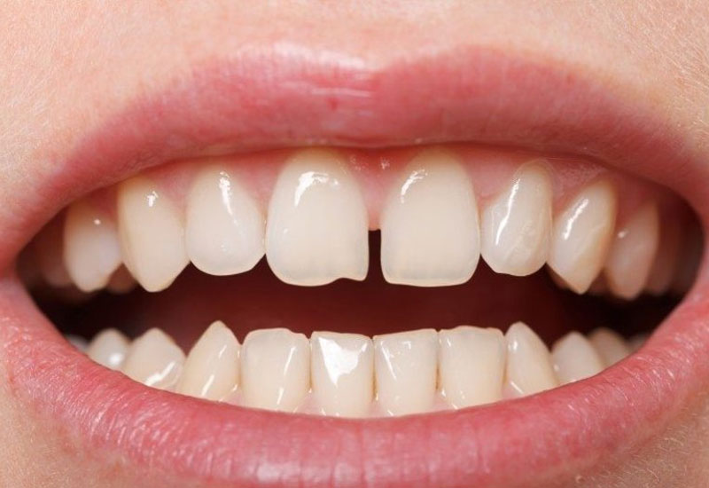 Trường hợp răng bị thưa sẽ không cần phải nhổ răng khi niềng