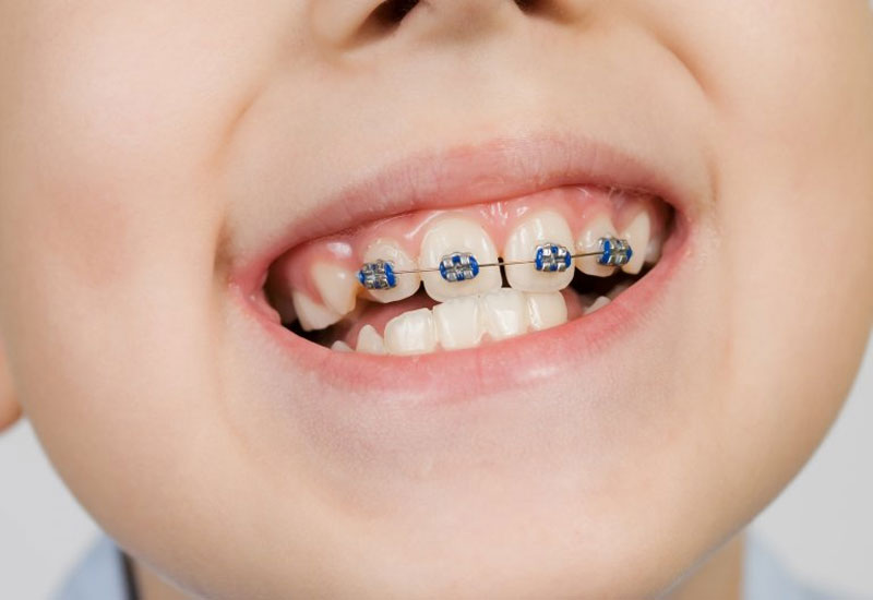 Với trẻ em, việc nhổ răng khi niềng răng hô là không cần thiết
