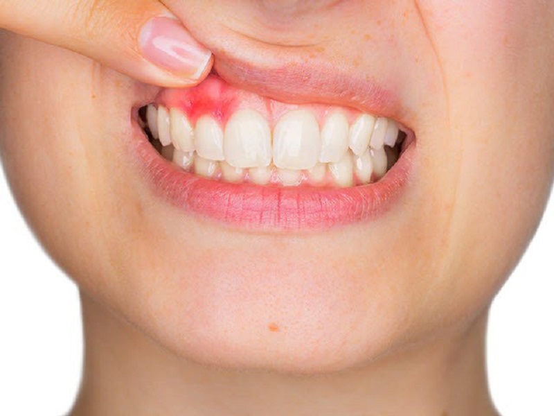 Viêm nướu là do các mảng bám trên răng làm kích ứng gây mẩn đỏ dẫn đến sưng nướu