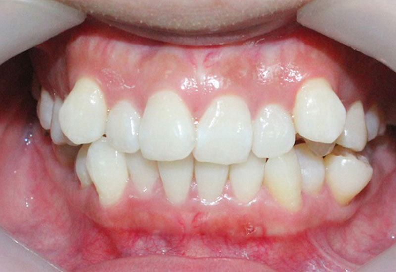 Răng khấp khểnh là tình trạng răng mọc sai vị trí hoặc hướng mọc
