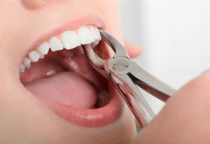 Nhổ hay không nhổ răng khểnh sẽ phụ thuộc vào tình trạng răng miệng của mỗi người