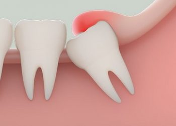 Răng khôn và những vấn đề khi mọc răng khôn