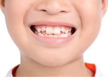 Răng mọc lệch ở trẻ em là hiện tượng rất thường gặp