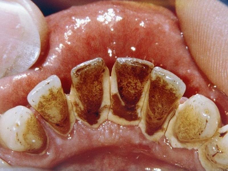Răng bị ố vàng có thể do quá trình vệ sinh răng miệng kém