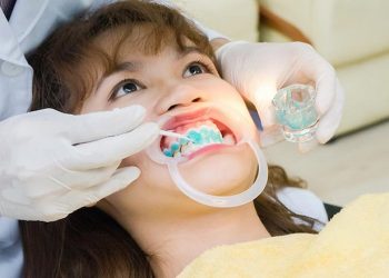 Tẩy răng sai cách có thể dẫn đến nhiều tác hại nguy hiểm