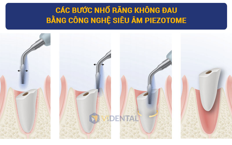 Kỹ thuật nhổ răng không đau bằng công nghệ siêu âm Piezotome