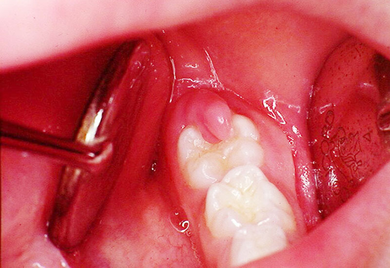 Sưng chân răng được xem là một dấu hiệu bệnh lý