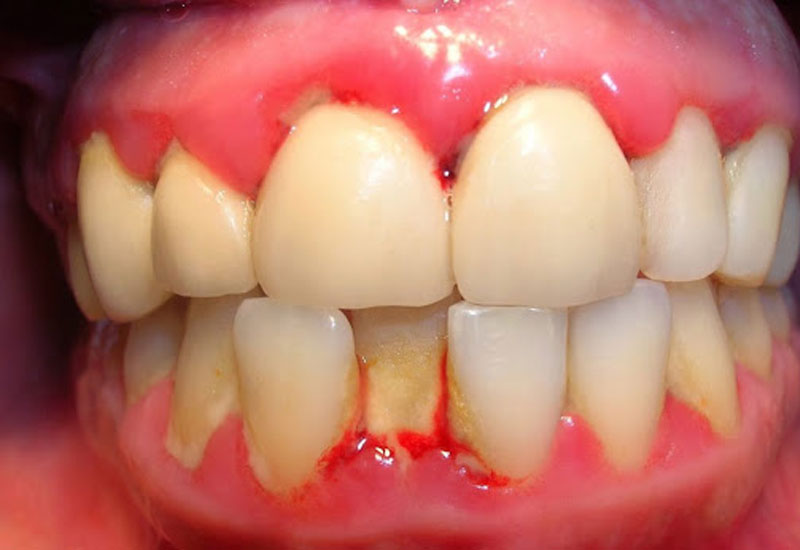 Có rất nhiều nguyên nhân có thể dẫn đến sưng chân răng