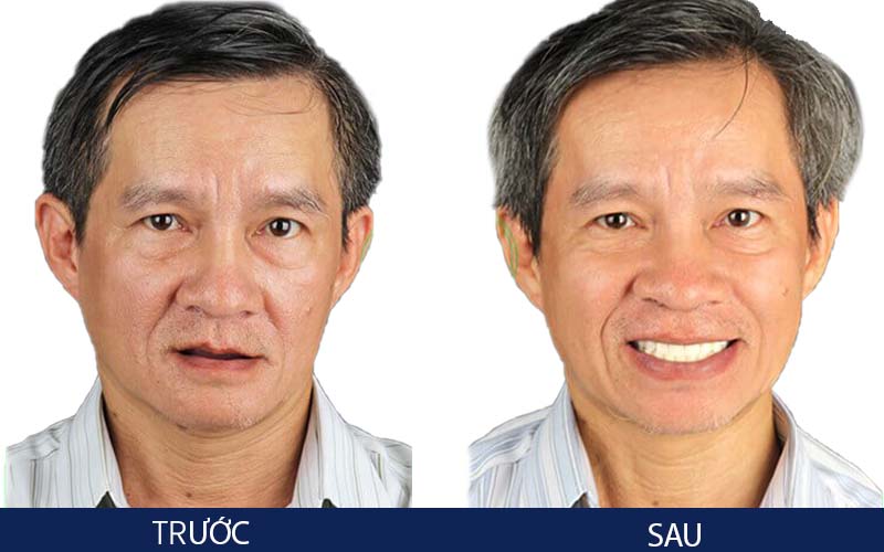 Chú Sơn trước và sau khi trồng răng Implant